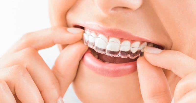 What Is the Use of Teeth Retainers?